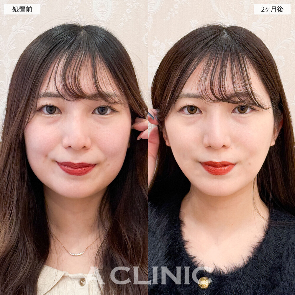 1day小顔脂肪吸引で他撮りも盛れる小顔に！こちら処置前と2ヶ月後の症例です(20代女性)