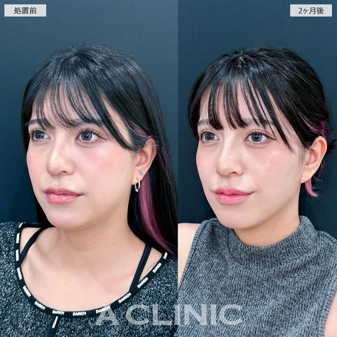 1day小顔脂肪吸引と小顔エラボトックスでフェイスラインのもたつきを解消しシュッとしたフェイスラインに！こちら処置前と2ヶ月後の症例です(20代女性)