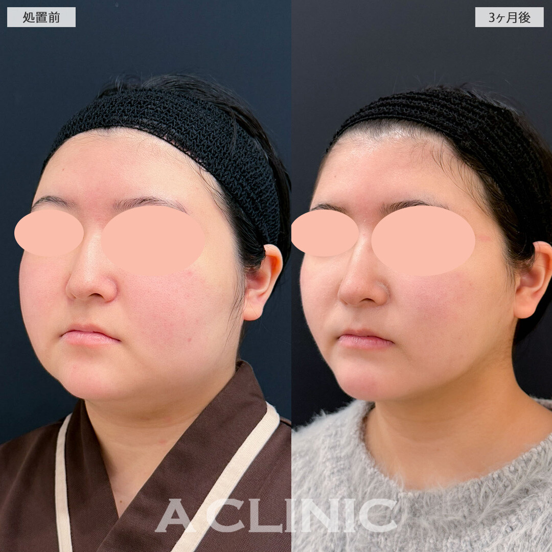1day小顔脂肪吸引でしっかりフェイスラインを作って別人級の小顔に！こちら処置前と3ヶ月後の症例です(20代女性)