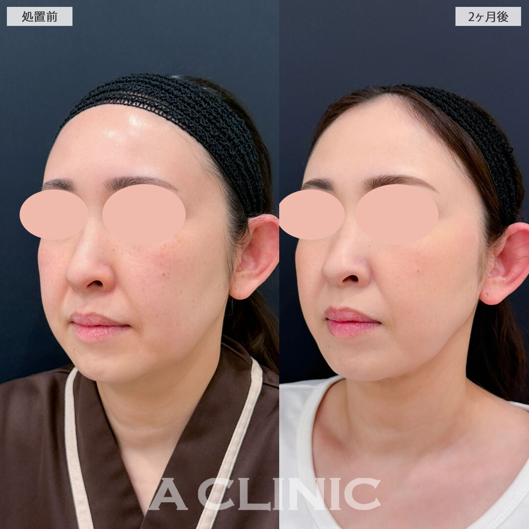 1day小顔脂肪吸引でたるみ引き上げてフェイスラインスッキリ！こちら処置前と2ヶ月後の症例です(40代女性)