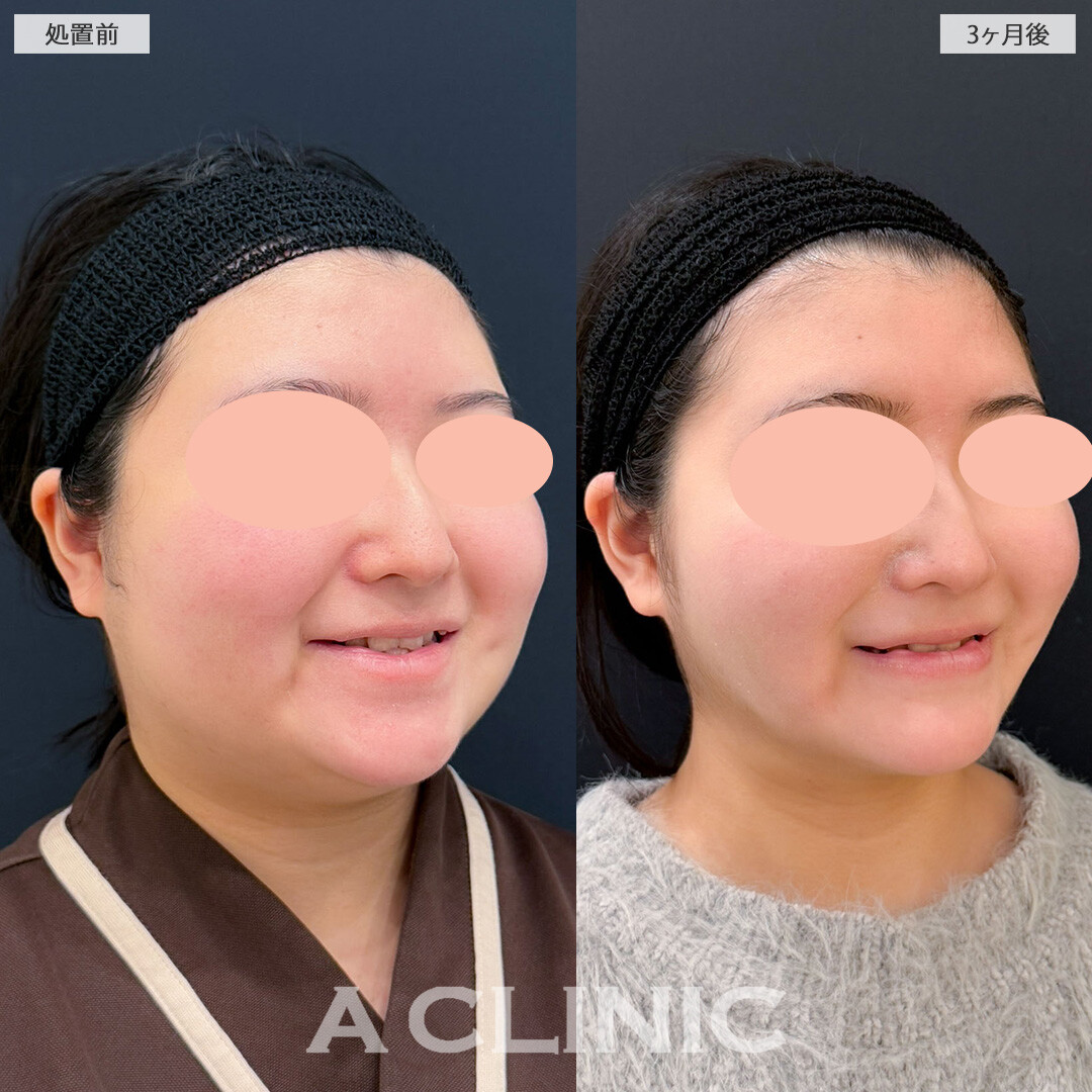 1day小顔脂肪吸引でしっかりフェイスラインを作って別人級の小顔に！こちら処置前と3ヶ月後の症例です(20代女性)