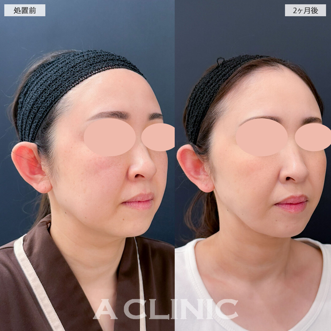 1day小顔脂肪吸引でたるみ引き上げてフェイスラインスッキリ！こちら処置前と2ヶ月後の症例です(40代女性)