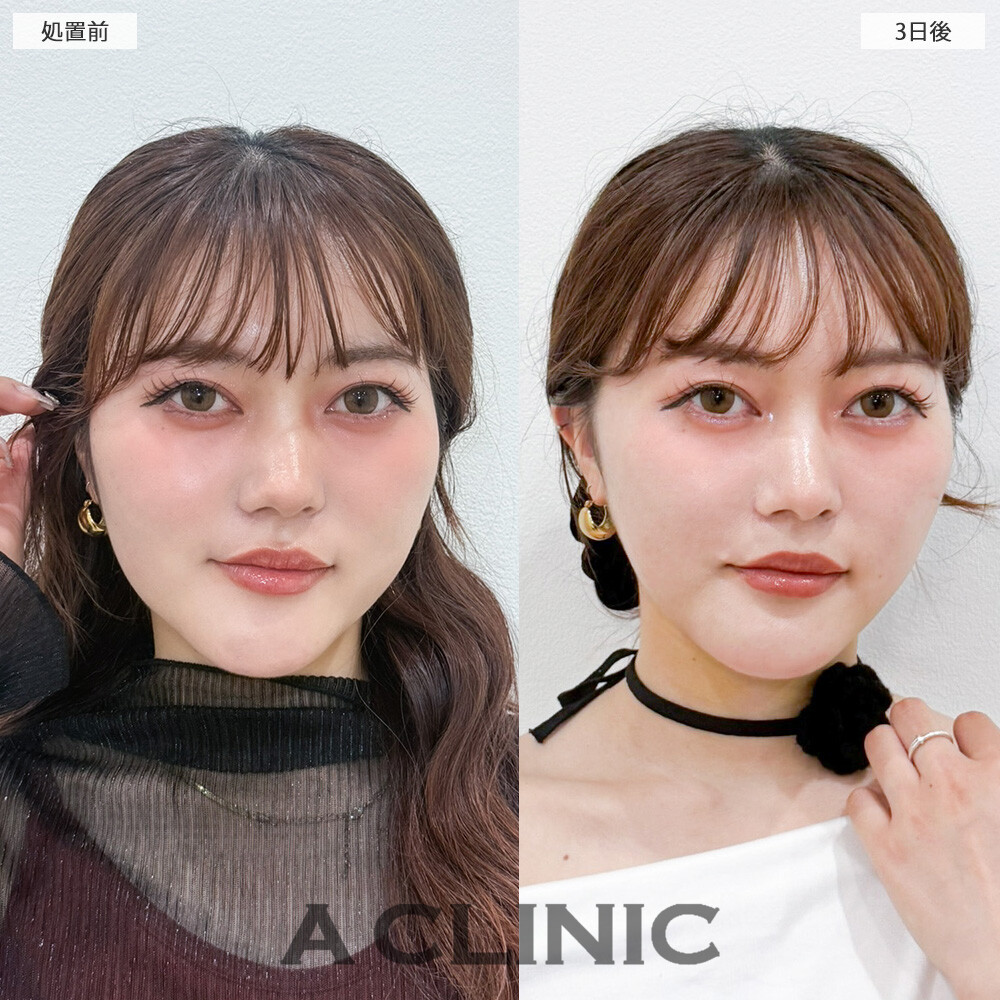 1day小顔脂肪吸引を受けて3日後なのに腫れ最小限！こちら処置前と3日後の症例です。(20代女性)