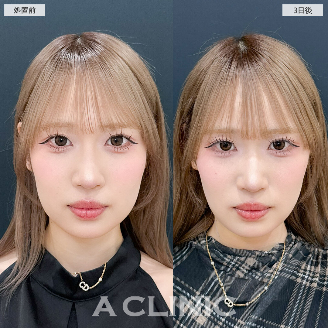 1day小顔脂肪吸引で顔の余白減らして小顔美女に！こちら処置前と3日後の症例です(20代女性)