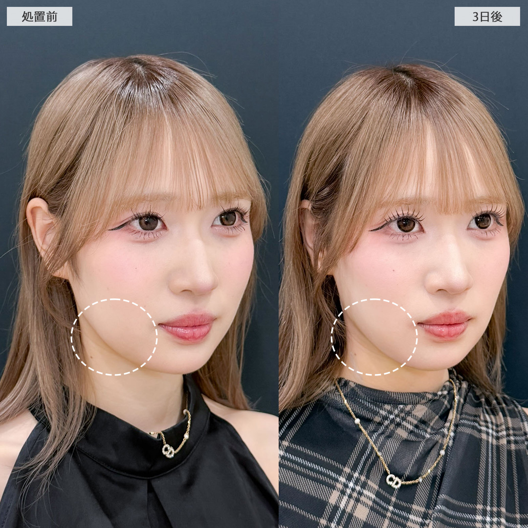 1day小顔脂肪吸引で顔の余白減らして小顔美女に！こちら処置前と3日後の症例です(20代女性)