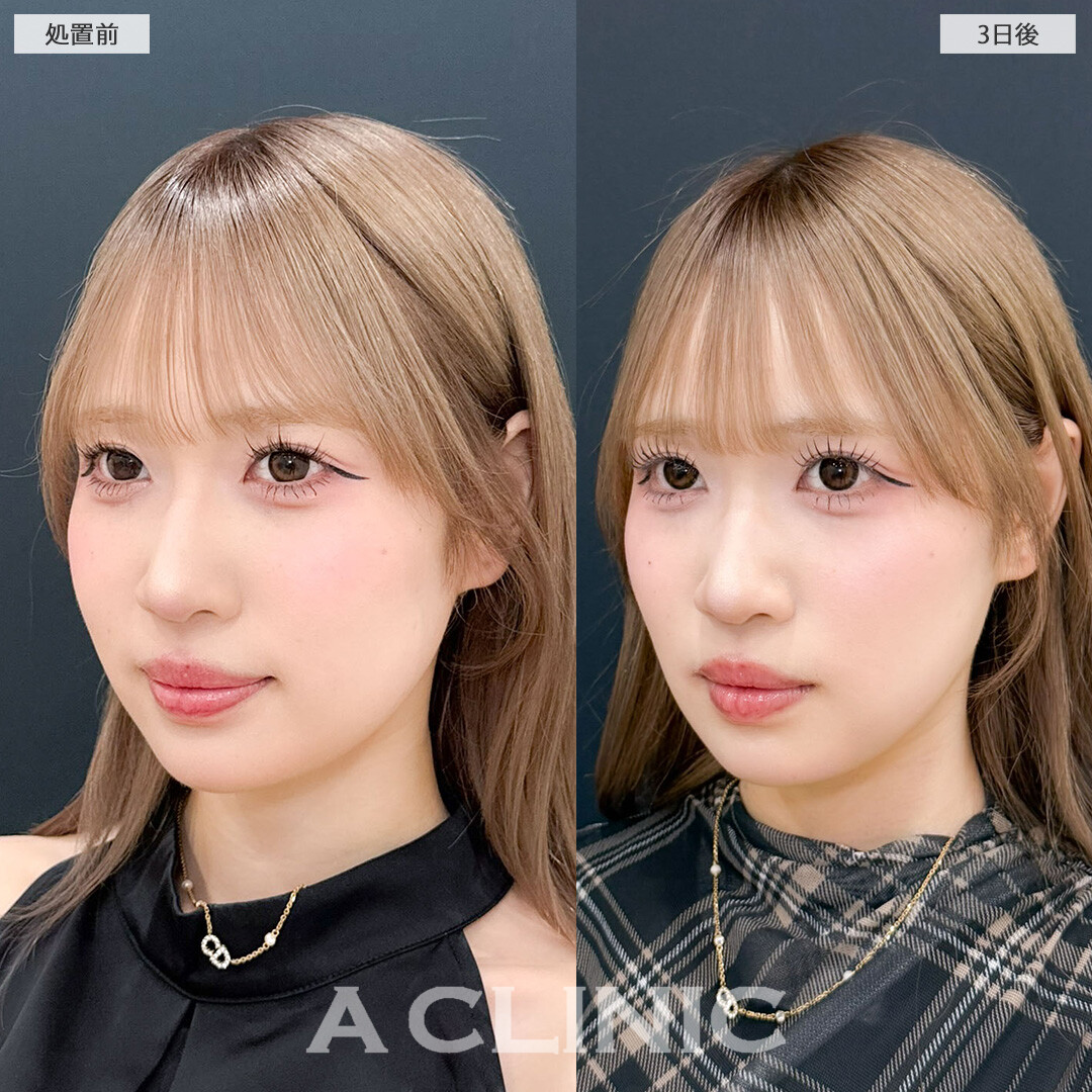 1day小顔脂肪吸引で顔の余白減らして小顔美女に！こちら処置前と3日後の症例です(20代女性)