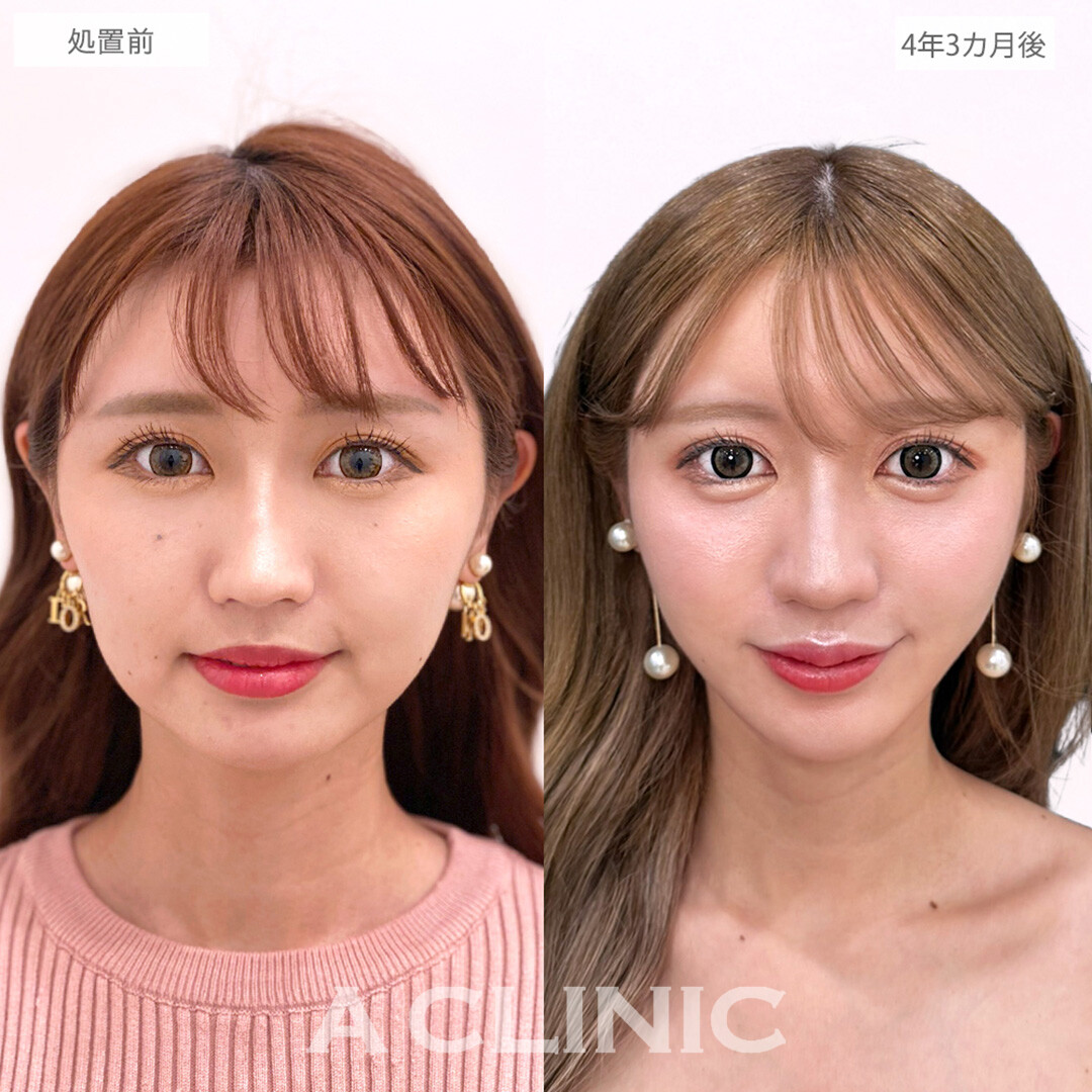 1day小顔脂肪吸引で後戻りせず一生モノの小顔へ！こちら処置前と4年3カ月後の症例です(20代女性)