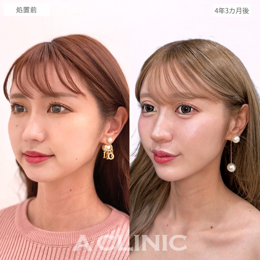 1day小顔脂肪吸引で後戻りせず一生モノの小顔へ！こちら処置前と4年3カ月後の症例です(20代女性)