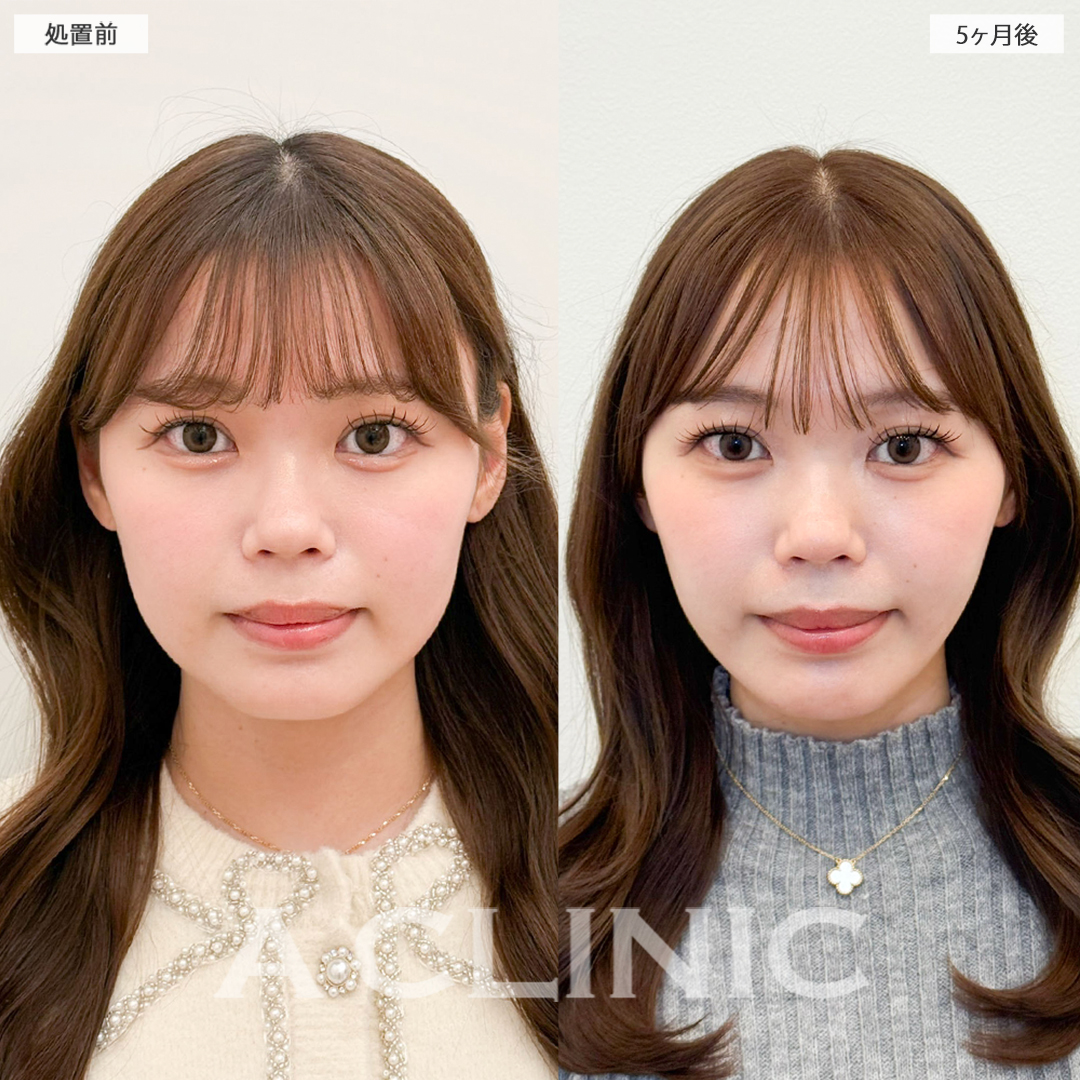 1day小顔脂肪吸引で可愛い印象から大人っぽい印象に！こちら処置前と5ヶ月後の症例です(20代女性)