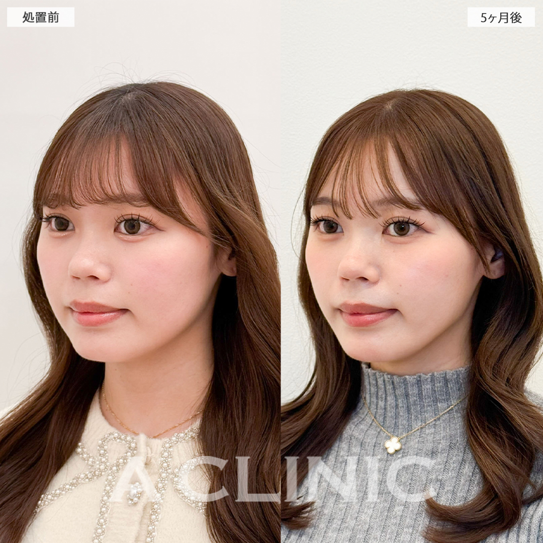 1day小顔脂肪吸引で可愛い印象から大人っぽい印象に！こちら処置前と5ヶ月後の症例です(20代女性)