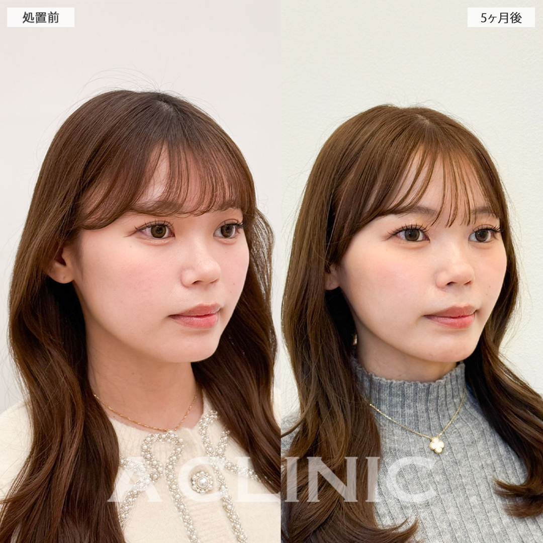 1day小顔脂肪吸引で可愛い印象から大人っぽい印象に！こちら処置前と5ヶ月後の症例です(20代女性)