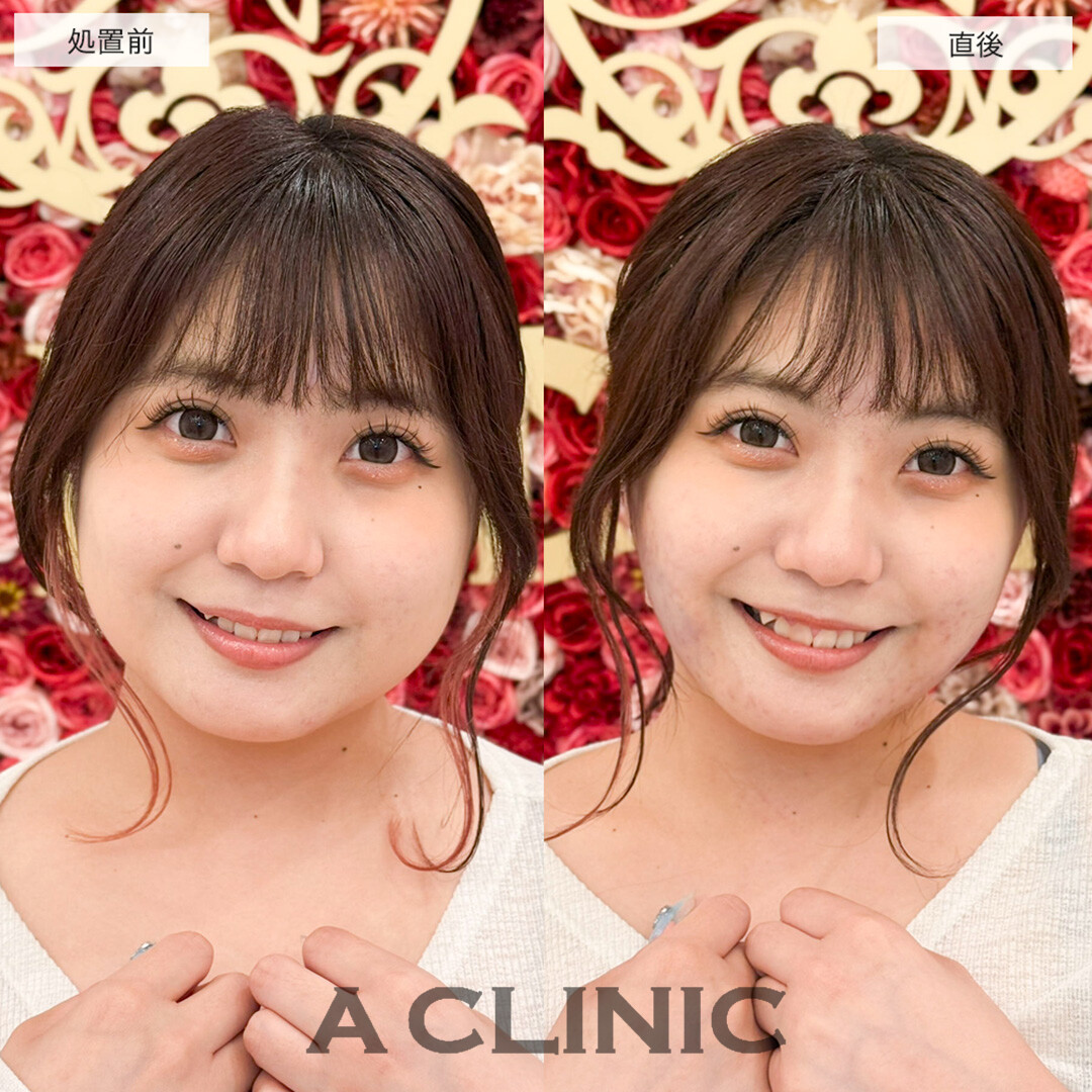 1day小顔脂肪吸引で顔が一回り小さくなり垢抜けました!こちら処置前と直後の症例です(20代女性)