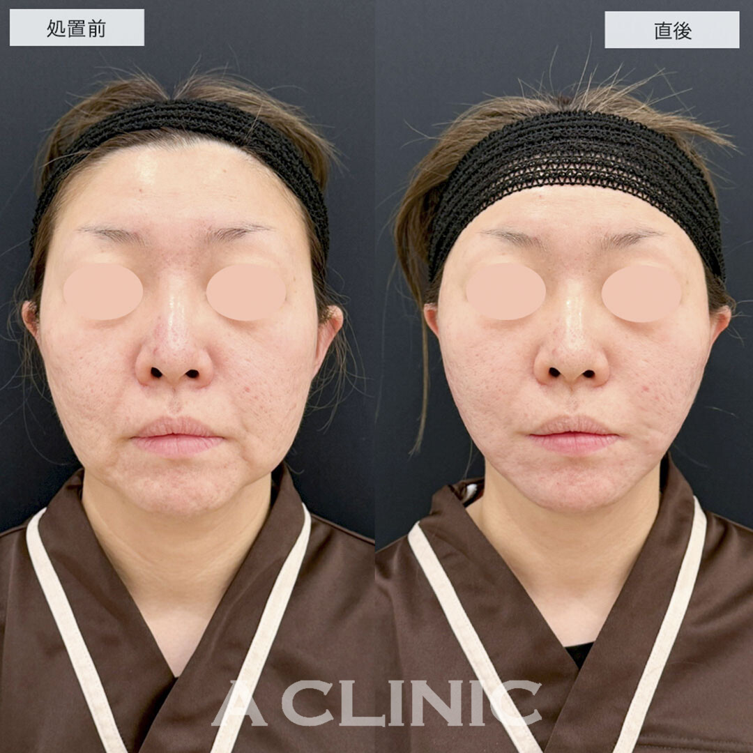 1day小顔脂肪吸引でたるみの原因である脂肪を除去し若々しい印象に!こちら処置前と直後の症例です(40代女性)
