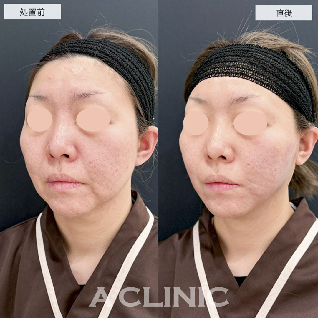 1day小顔脂肪吸引でたるみの原因である脂肪を除去し若々しい印象に!こちら処置前と直後の症例です(40代女性)