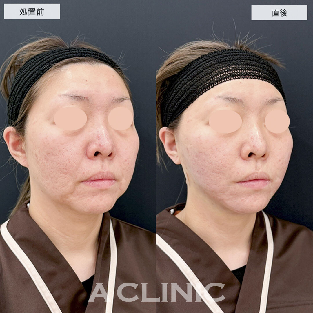 1day小顔脂肪吸引でたるみの原因である脂肪を除去し若々しい印象に!こちら処置前と直後の症例です(40代女性)
