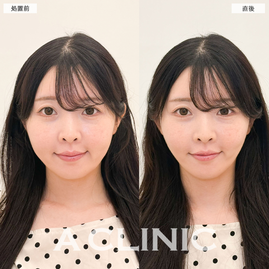 Aスレッドでフェイスラインのもたつき解消！こちら処置前と直後の症例です(30代女性)