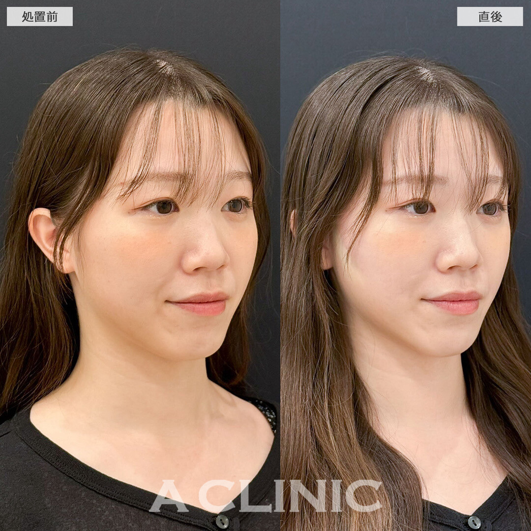 Aスレッドでフェイスラインのもたつき改善!こちら処置前と直後の症例です(20代女性)