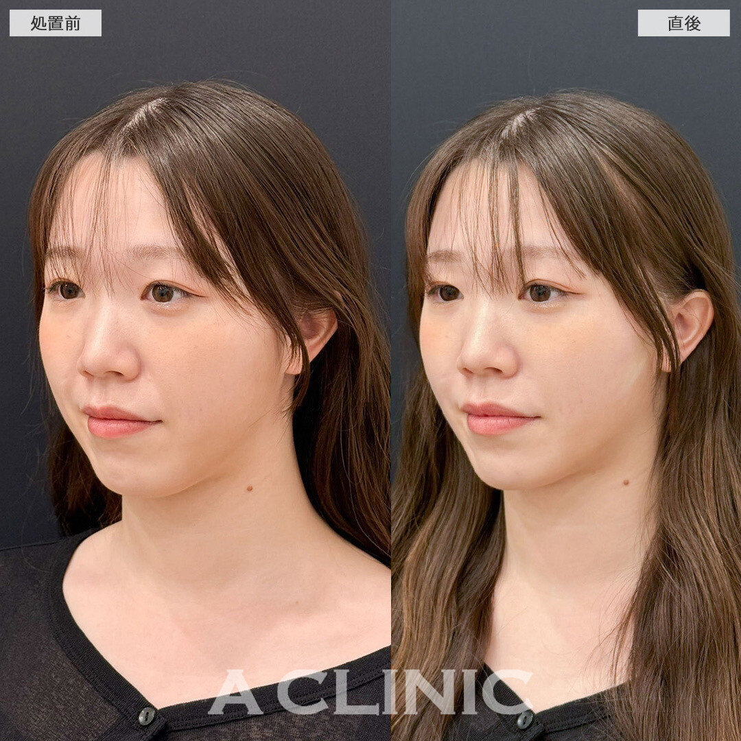 Aスレッドでフェイスラインのもたつき改善!こちら処置前と直後の症例です(20代女性)