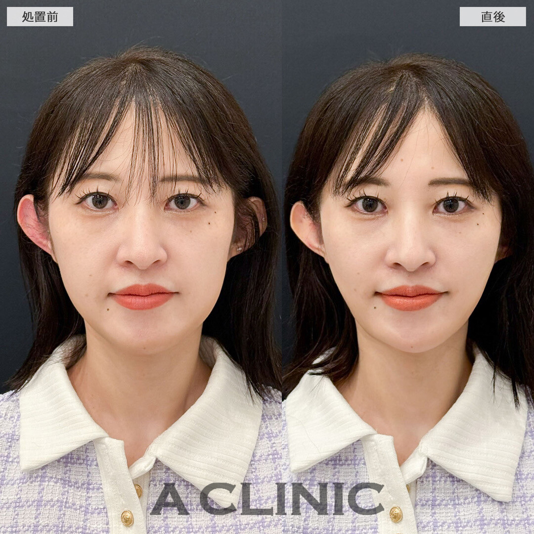 Aスレッドで左右差改善しました！こちら処置前と直後の症例です(30代女性)