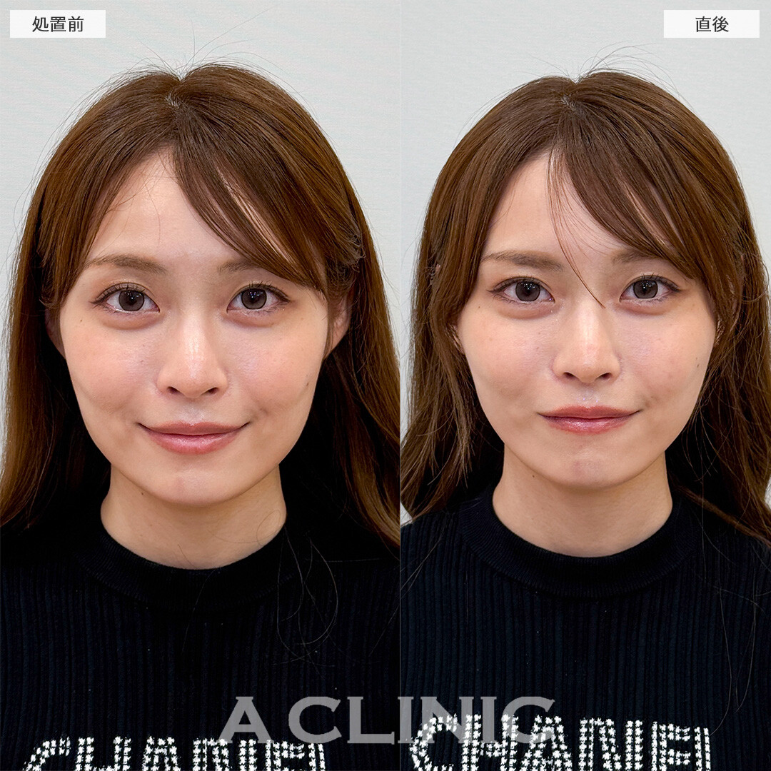 Aスレッドでマリオネットラインが薄くなりもたつきが解消されました！処置前と直後の症例です(20代女性)