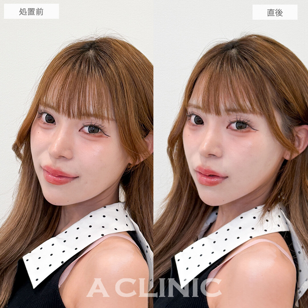 Aスレッドで口横のもたつき解消！こちら処置前と直後の症例です(20代女性)