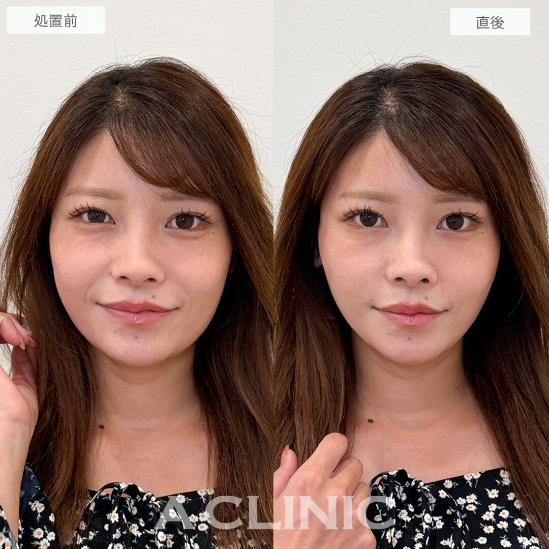 Aスレッドで直後から一回り小顔に！こちら処置前と直後の症例です(30代女性)