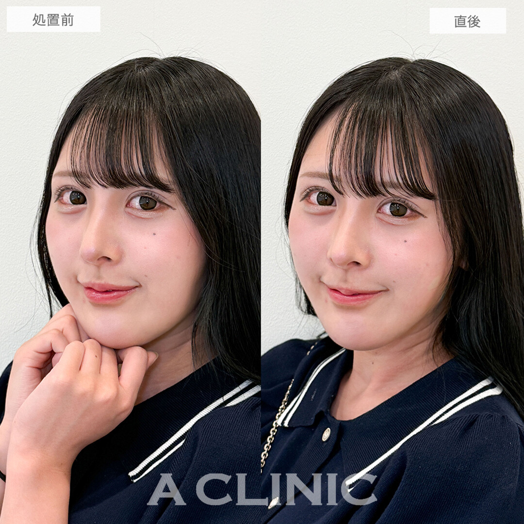 Aスレッドで面長感を改善！こちら処置前と直後の症例です(20代女性)