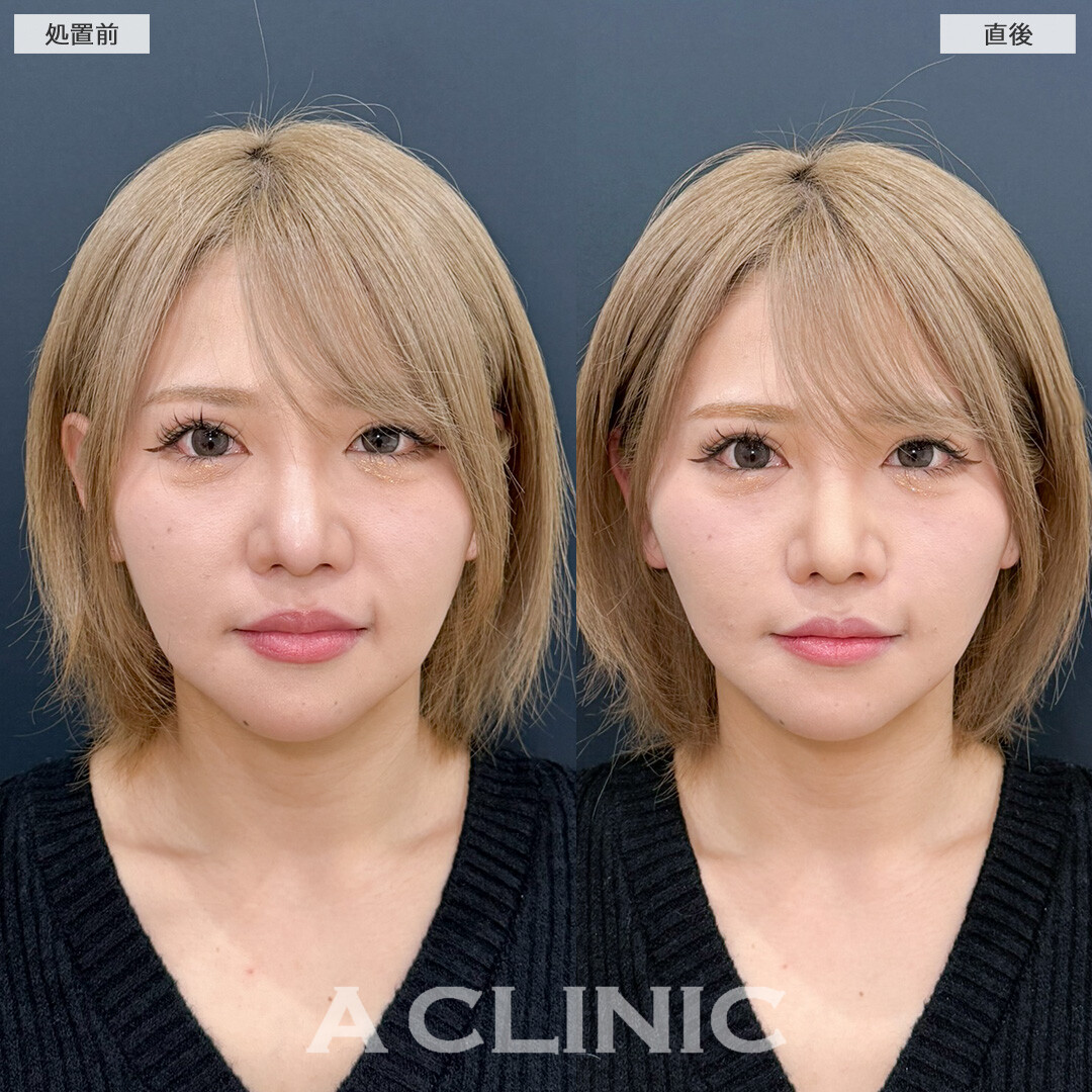 Ａスレッドとほうれい線へのヒアルロン酸注射(シワ)でたるみを撃退し一気に若見え！処置前と直後の症例です(30代女性)