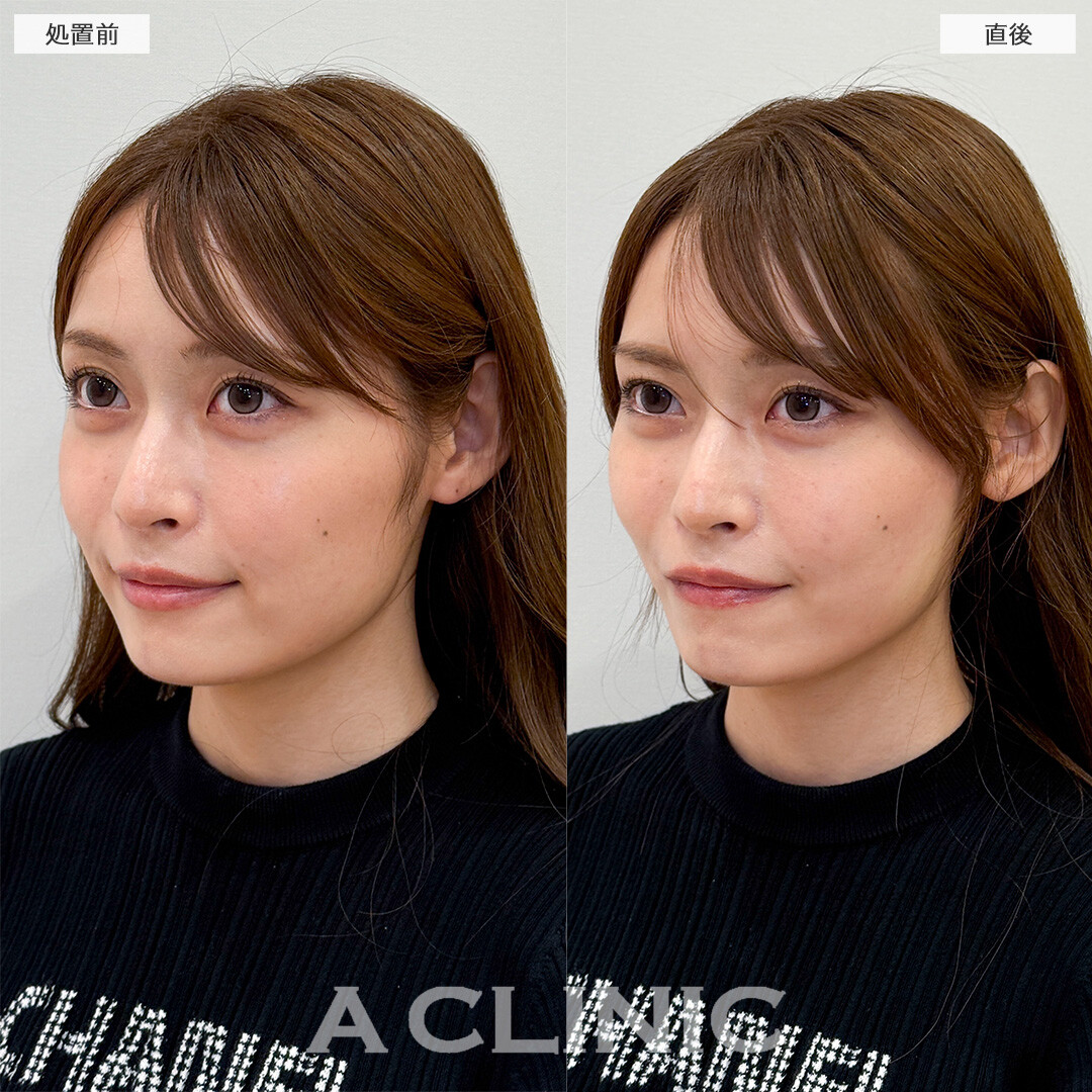 Aスレッドでマリオネットラインが薄くなりもたつきが解消されました！処置前と直後の症例です(20代女性)