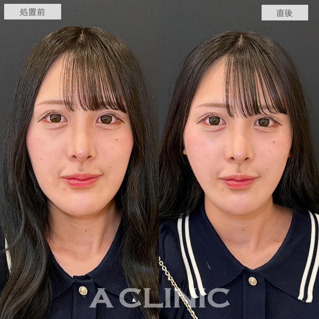 Aスレッドで面長感を改善！こちら処置前と直後の症例です(20代女性)