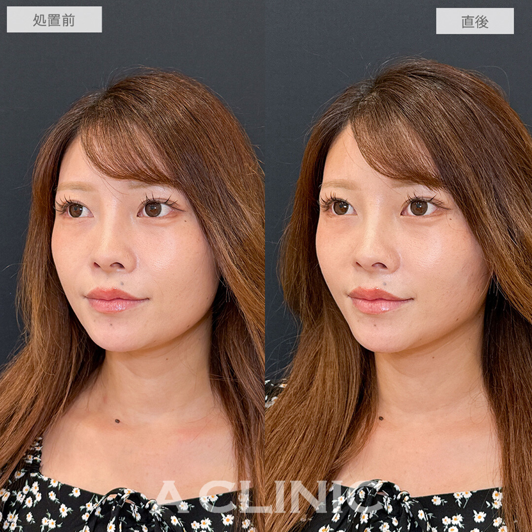 Aスレッドで直後から一回り小顔に！こちら処置前と直後の症例です(30代女性)