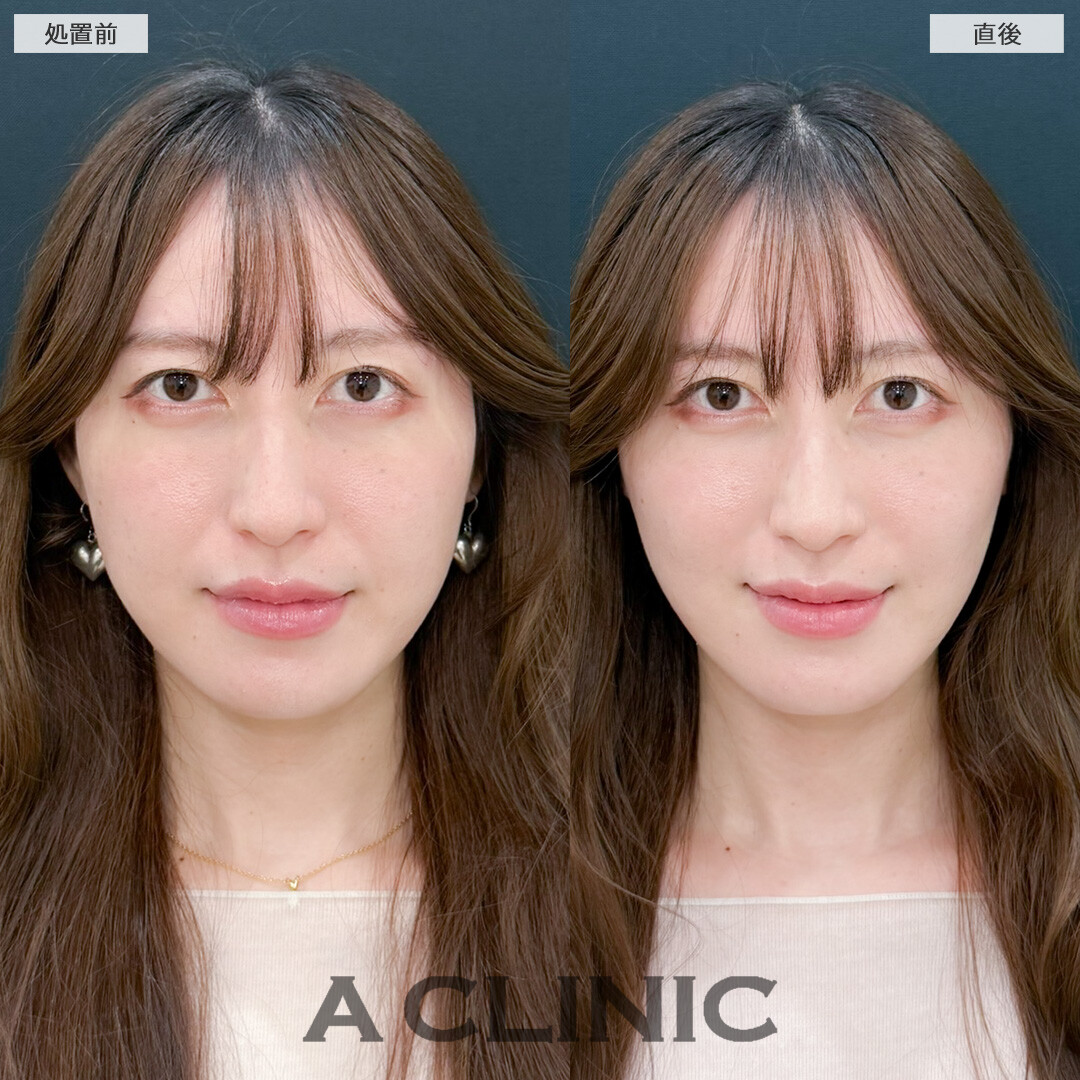 Aスレッドでフェイスラインとほうれい線を同時に引き上げ！処置前と直後の症例です(30代女性)