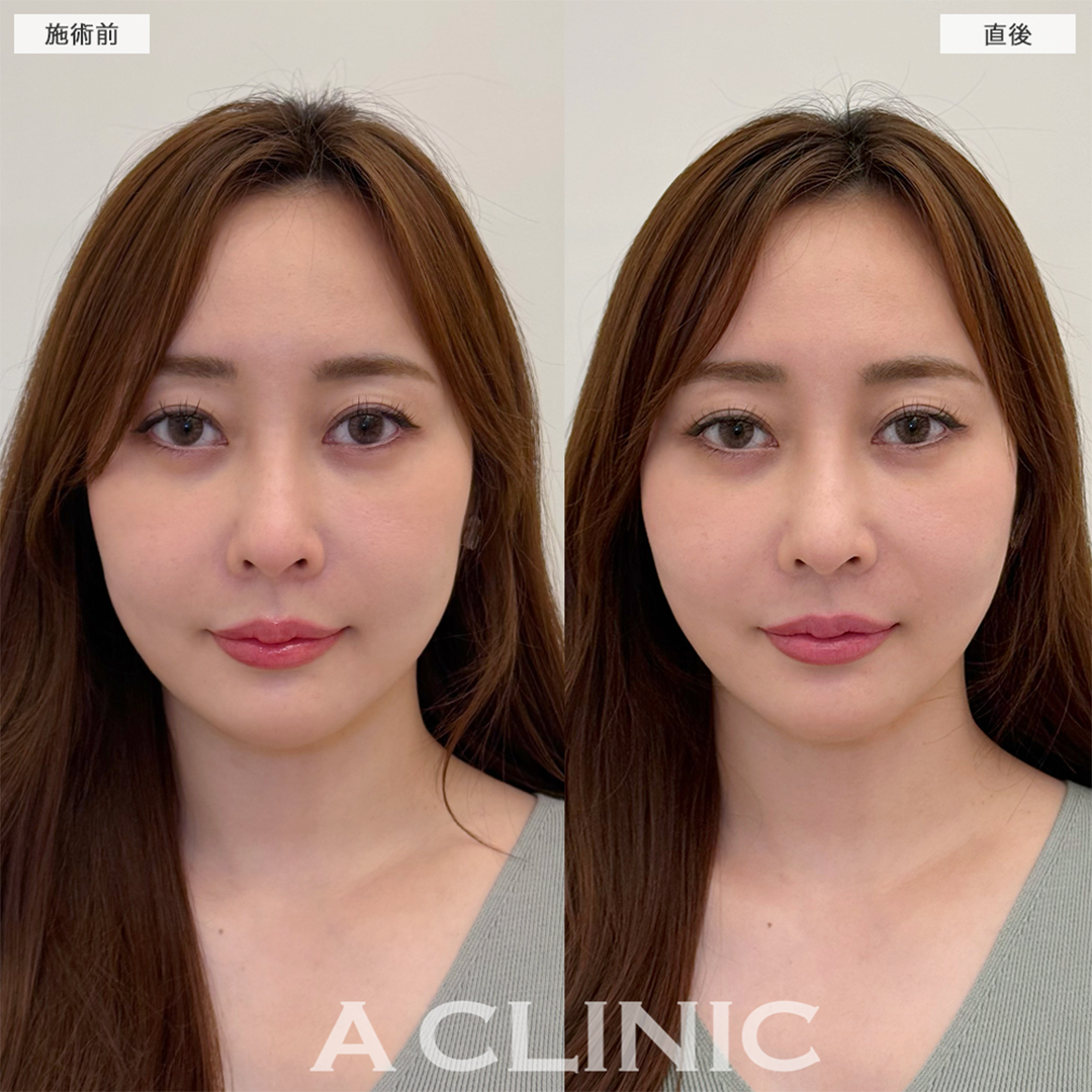 Aスレッドで8ヶ月ぶりのメンテナンスへ！こちら処置前と直後の症例です(30代女性)