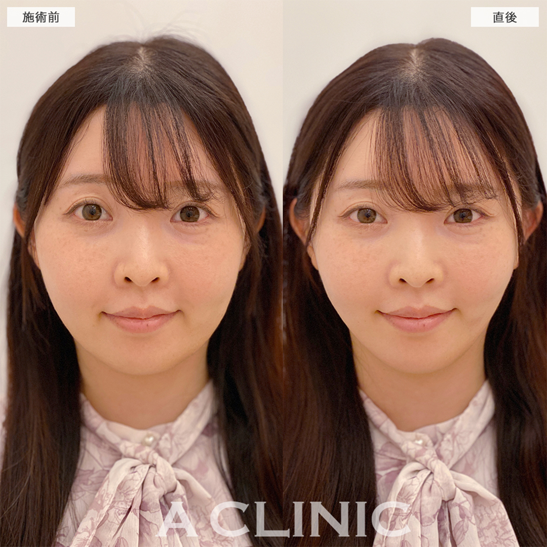 Aスレッドで2年ぶりのメンテナンスしました！こちら処置前と直後の症例です(30代女性)