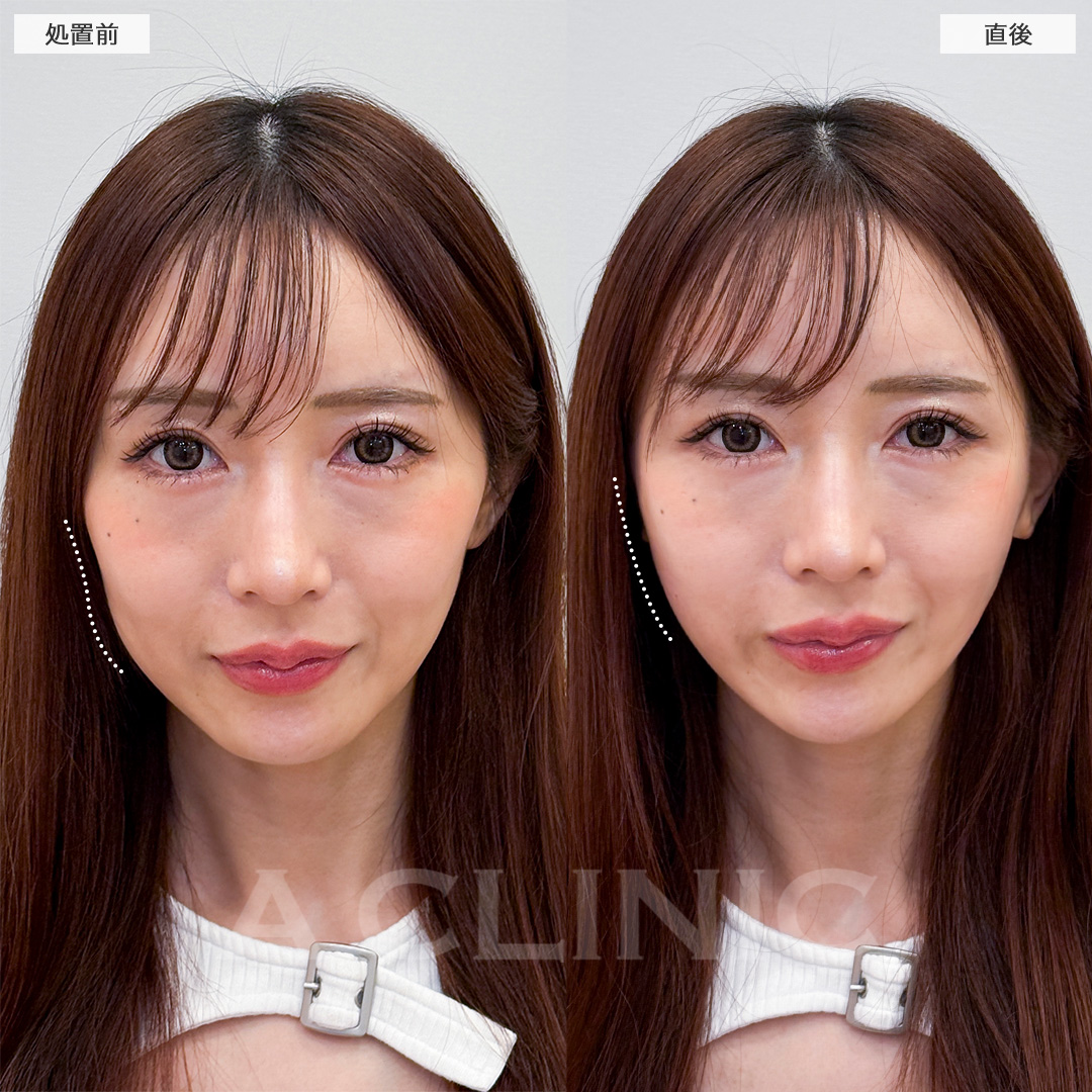 Aスレッドで頬こけを改善しつつシャープな輪郭へ！処置前と直後の症例です(30代女性)