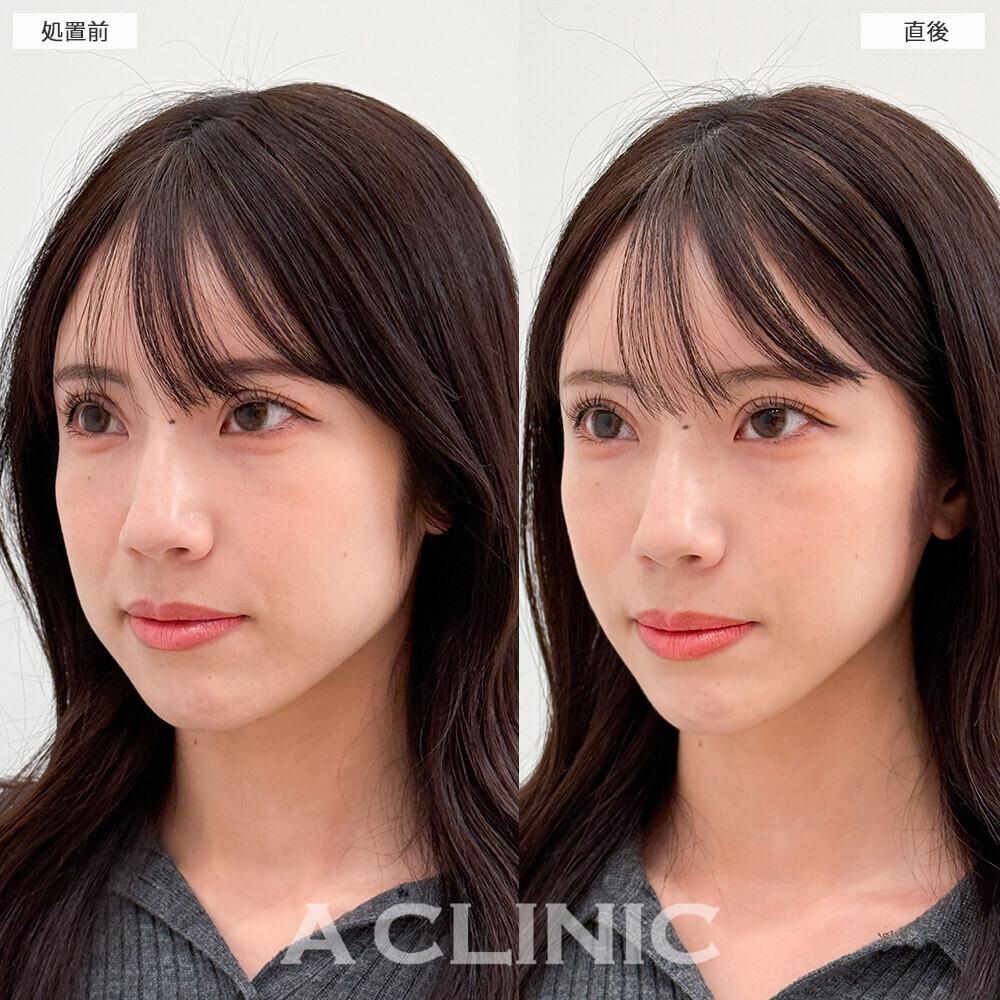 Aスレッドで余白がなくなりバランスの良いお顔に！こちら処置前と直後の症例です。(30代女性)