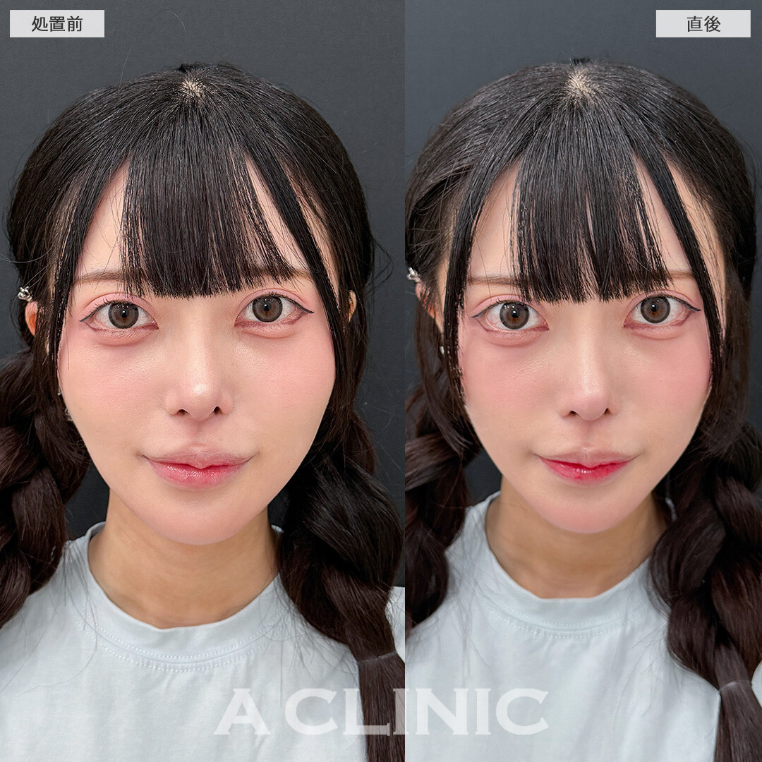 たるみやもたつきを即日解消して憧れのVフェイスに！こちらAスレッドの処置前と直後の症例です(20代女性)