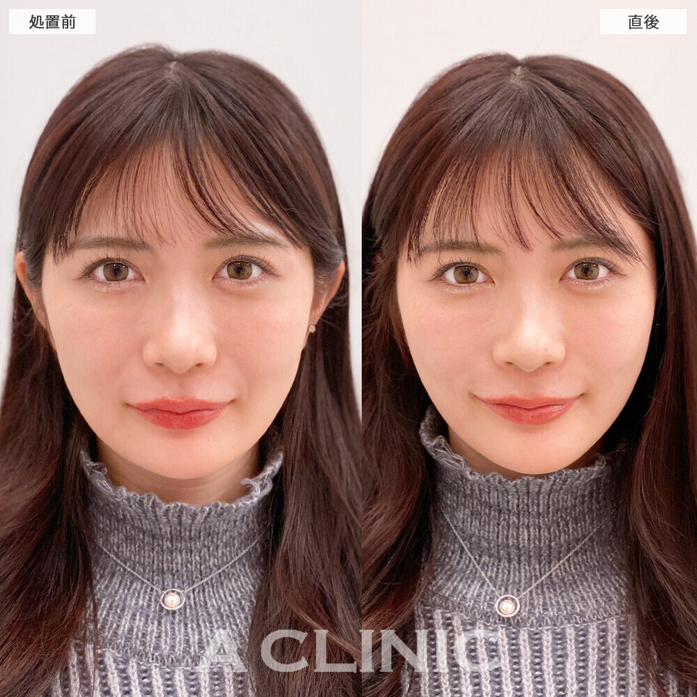 Aスレッドでほうれい線が薄くなりリフトアップしました！こちら処置前と直後の症例です(20代女性)
