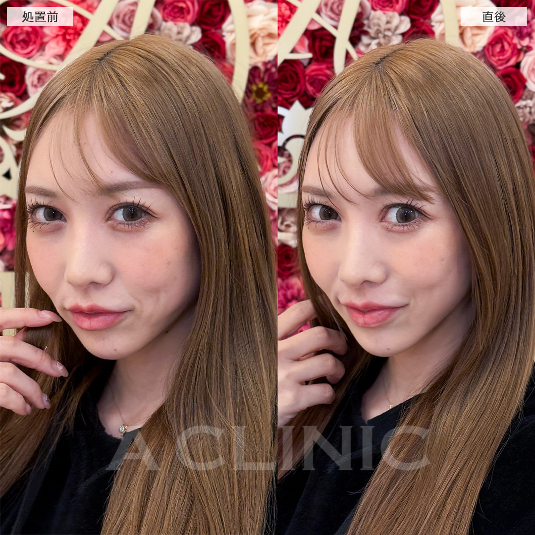 Aスレッドでフェイスラインのたるみがなかったことに！処置前と直後の症例です(30代女性)