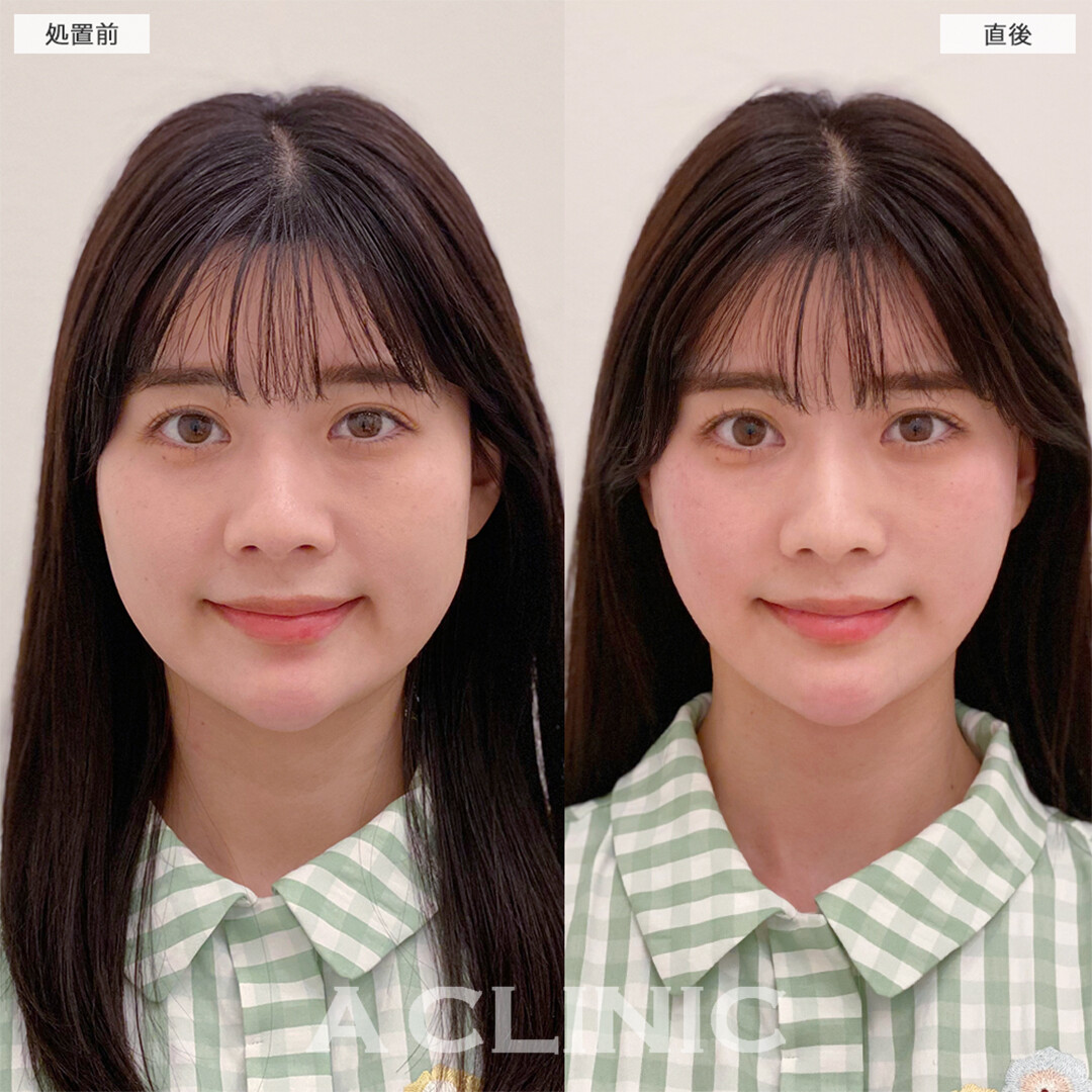 Aスレッドで余白ゼロの綺麗な輪郭になりました！こちら処置前と直後の症例です(30代女性)