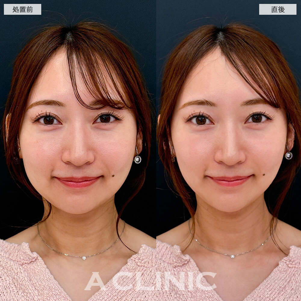 Aスレッドで頬のたるみがしっかりリフトアップされました！こちら処置前と直後の症例です(20代女性)