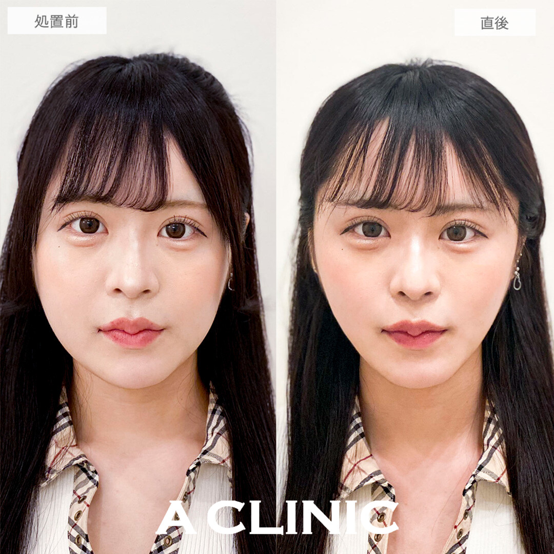 Aスレッドで輪郭の左右差が改善して韓国アイドルのようなVライン輪郭になりました！こちら処置前と直後の症例です。(10代女性)
