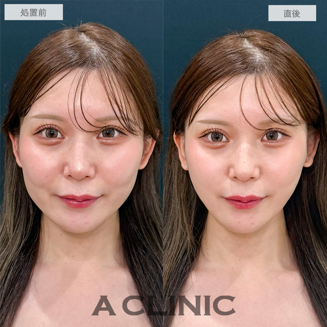 Aスレッドで口横のもたつき感が解消して輪郭が整いました！処置前と直後の症例です(20代女性)