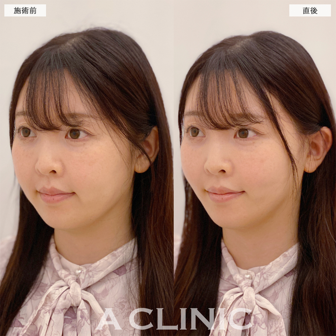 Aスレッドで2年ぶりのメンテナンスしました！こちら処置前と直後の症例です(30代女性)