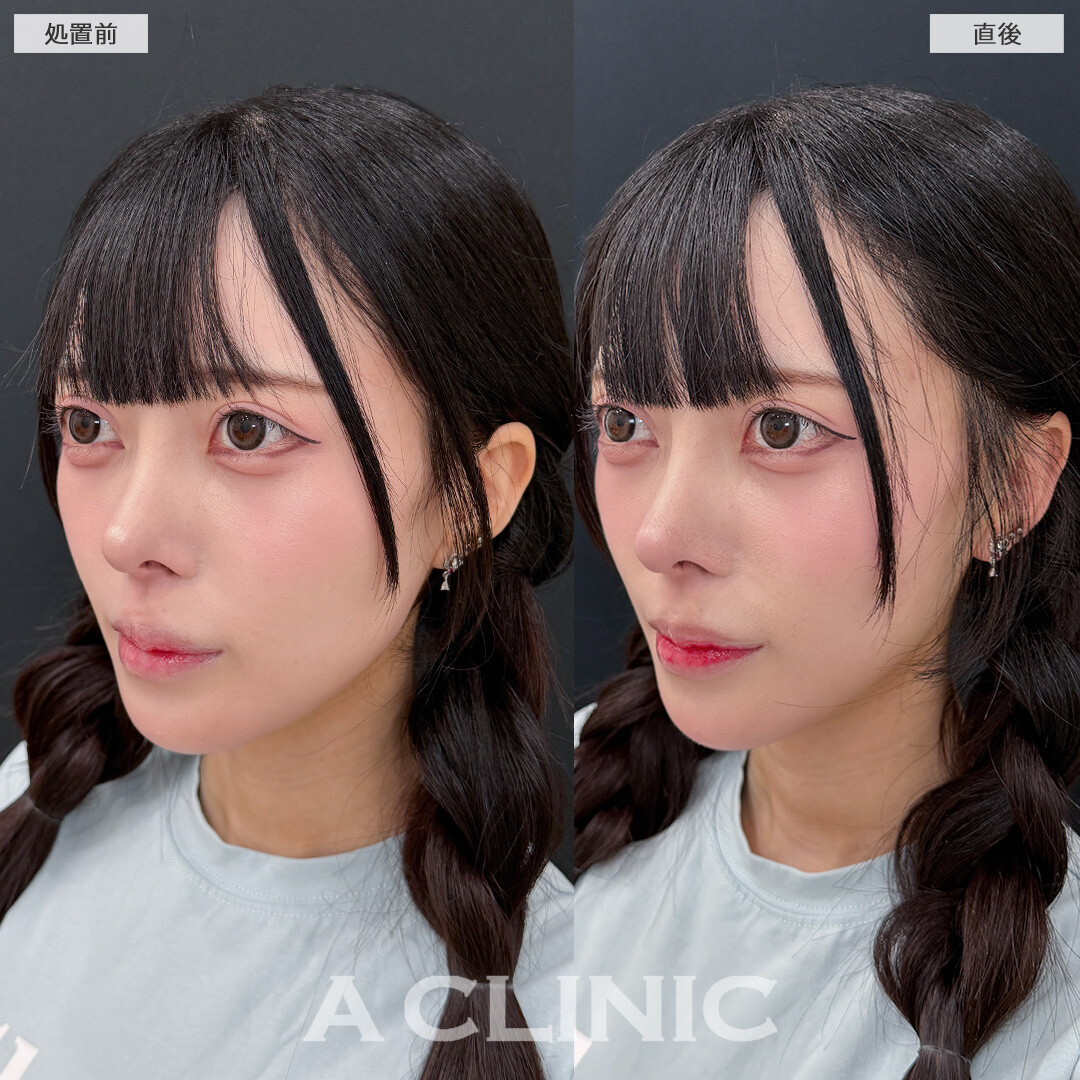 たるみやもたつきを即日解消して憧れのVフェイスに！こちらAスレッドの処置前と直後の症例です(20代女性)