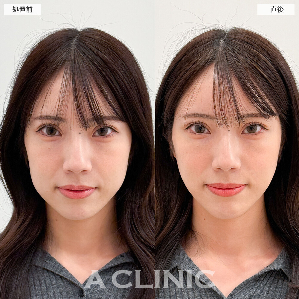Aスレッドで余白がなくなりバランスの良いお顔に！こちら処置前と直後の症例です。(30代女性)