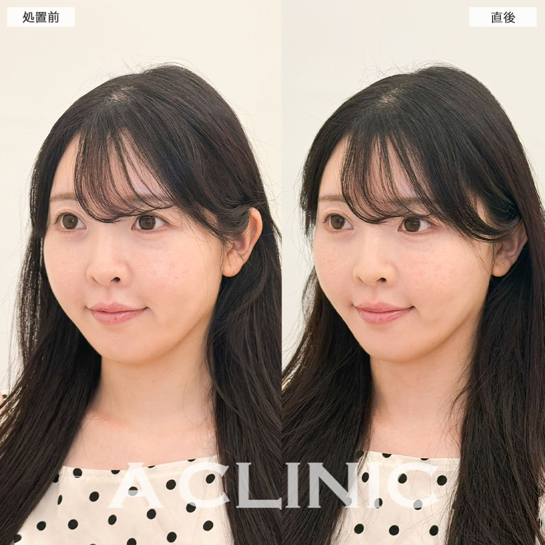 Aスレッドでフェイスラインのもたつき解消！こちら処置前と直後の症例です(30代女性)