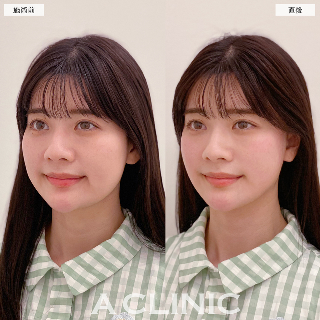 Aスレッドで余白ゼロの綺麗な輪郭になりました！こちら処置前と直後の症例です(30代女性)