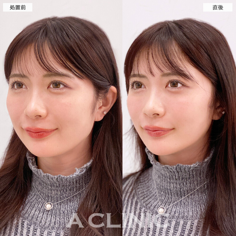Aスレッドでほうれい線が薄くなりリフトアップしました！こちら処置前と直後の症例です(20代女性)
