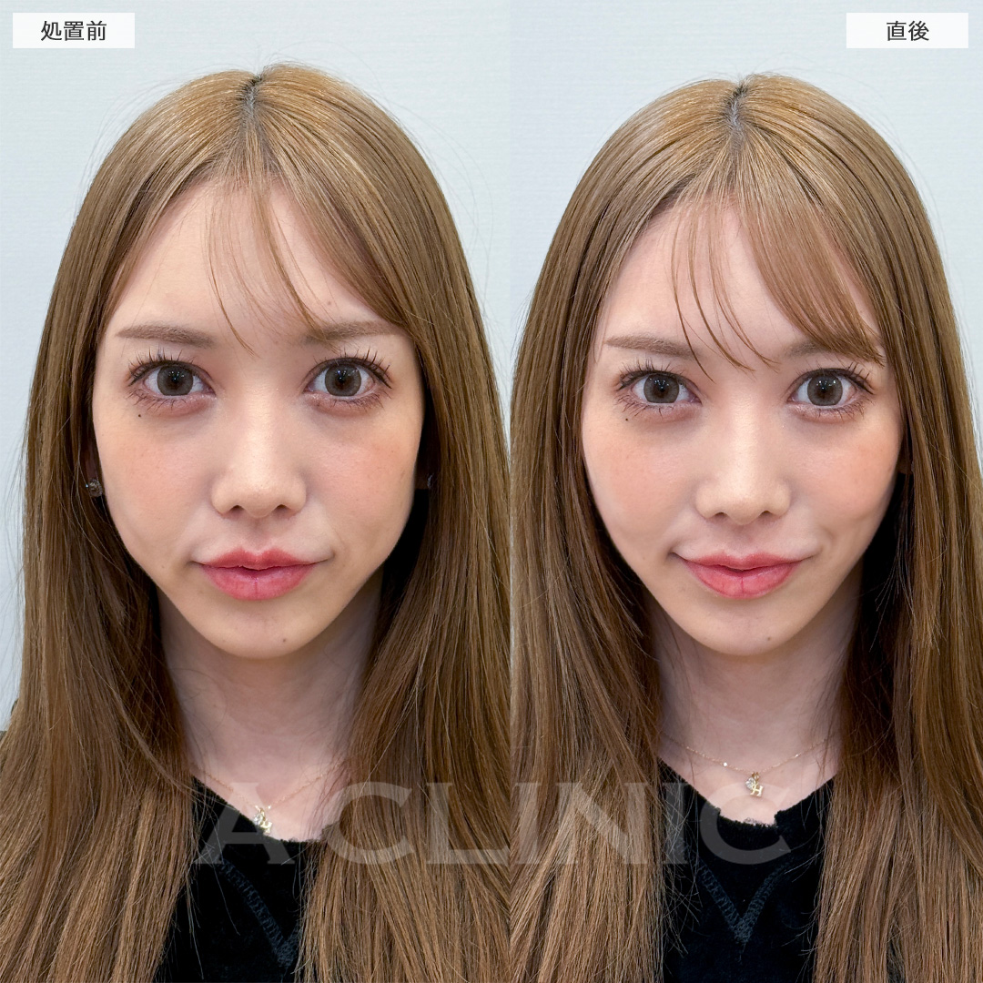 Aスレッドでフェイスラインのたるみがなかったことに！処置前と直後の症例です(30代女性)